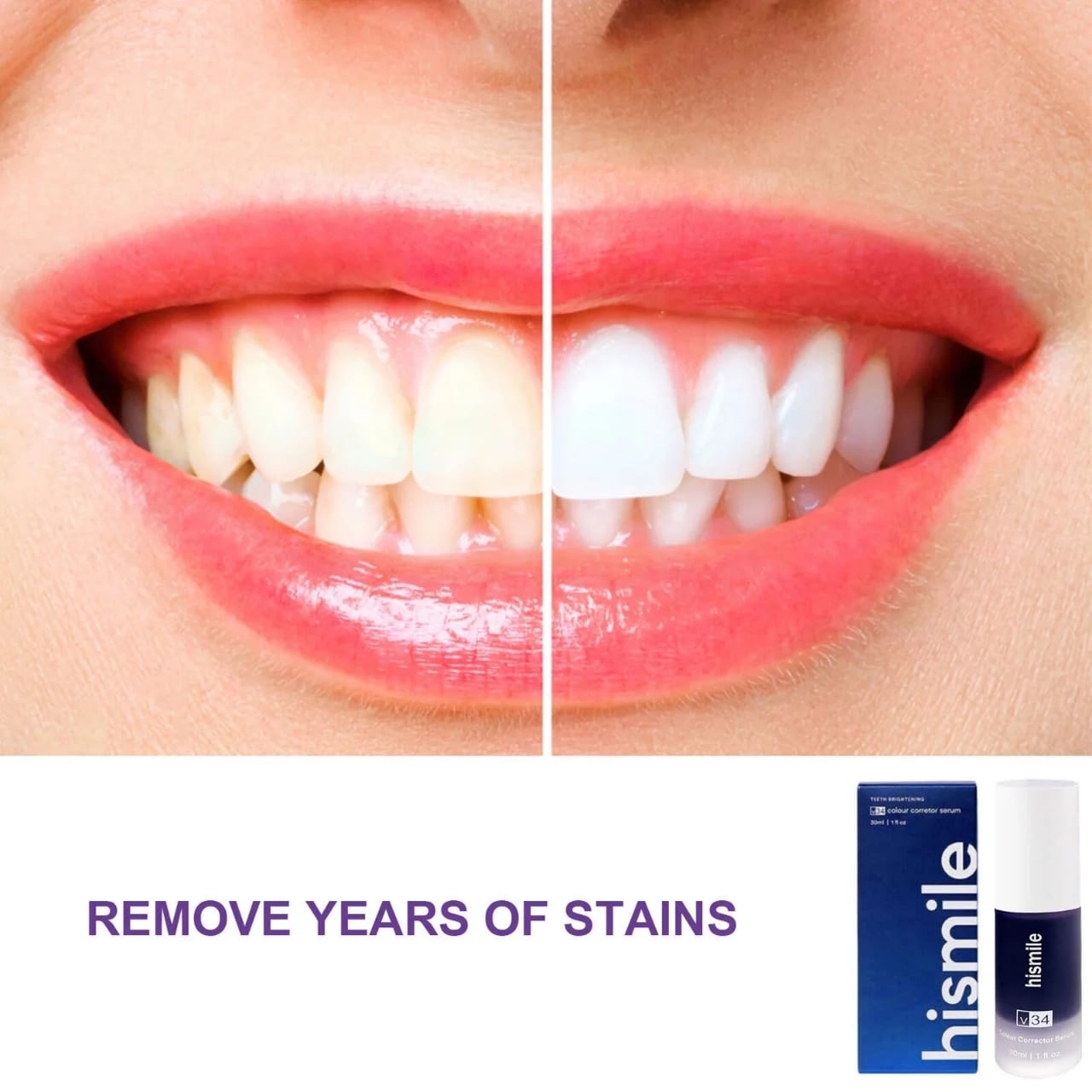 Hismile V34 Teeth Whitening