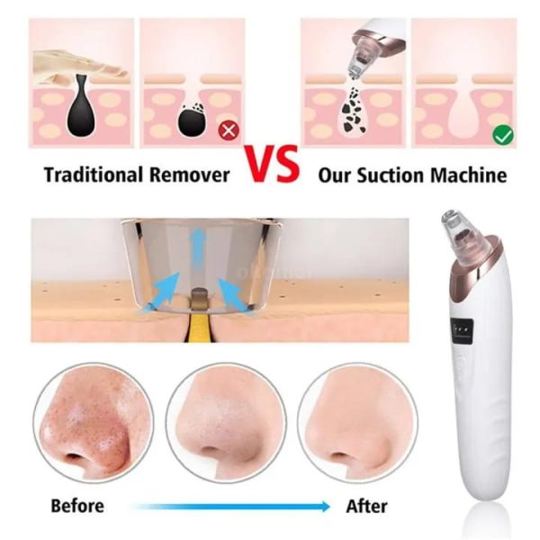 Vacuum Suction Blackhead Remover