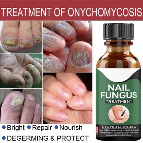 Foot Nail Fungus Removal Gel