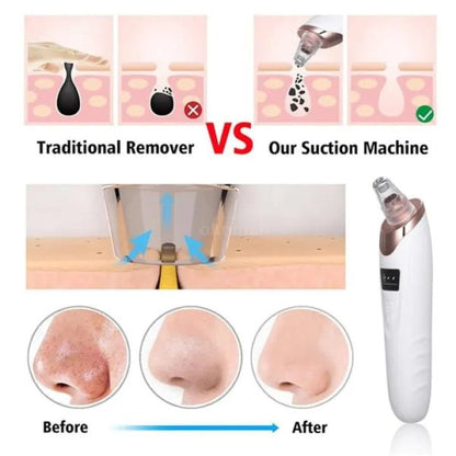 Vacuum Suction Blackhead Remover
